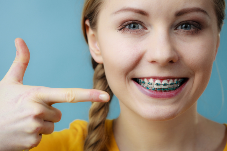 Traditional Braces