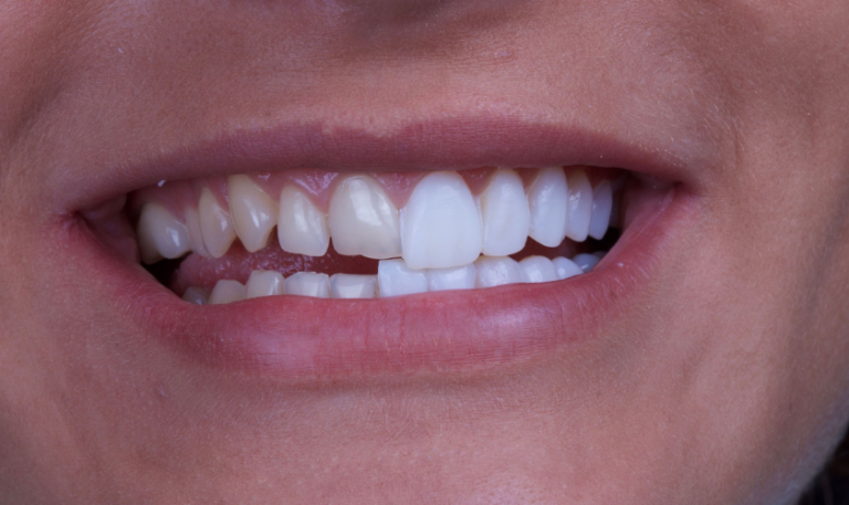 Porcelain Veneers